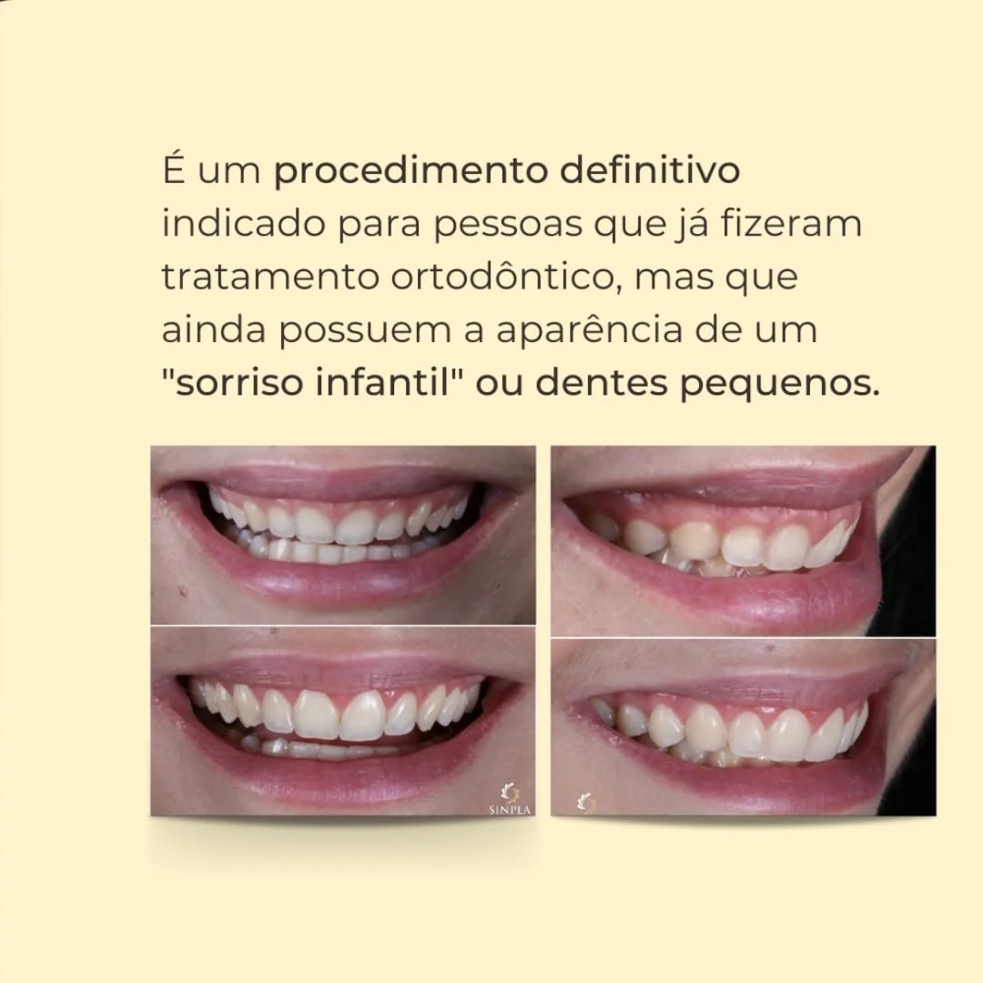 Plastica-Sorriso-4